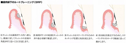 歯周病治療の基本 ～ルートプレーニング（SRP）～
