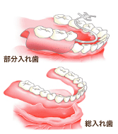 部分入れ歯・総入れ歯