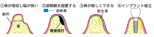 ＧＢＲ（骨組織誘導再生）